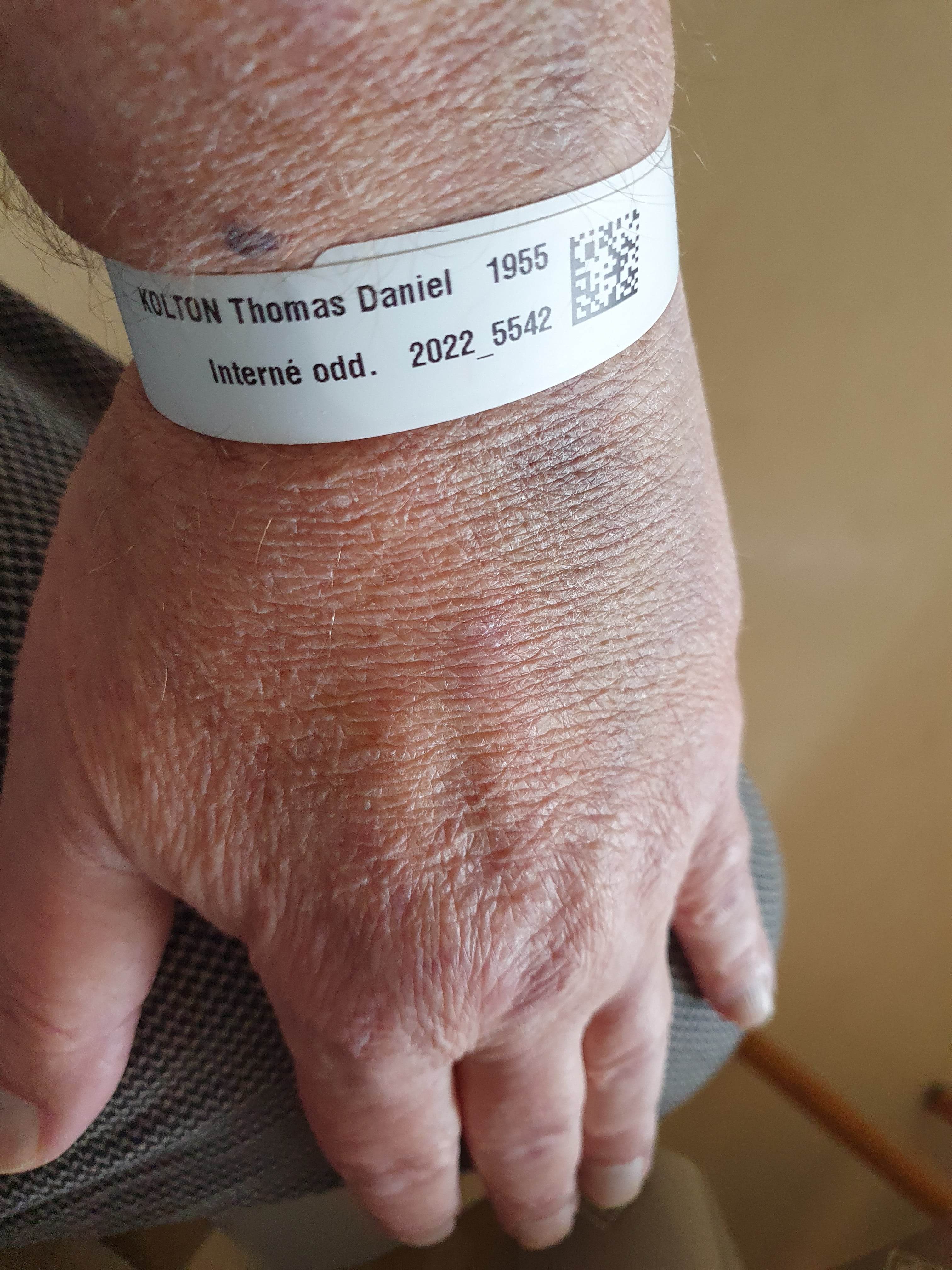 Thom's hand and wristband